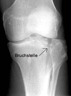 broken bone labeled Bruchstele