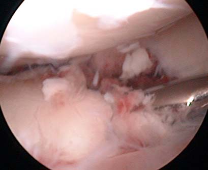 Looking into the knee by arthroscope during surgical treatment
